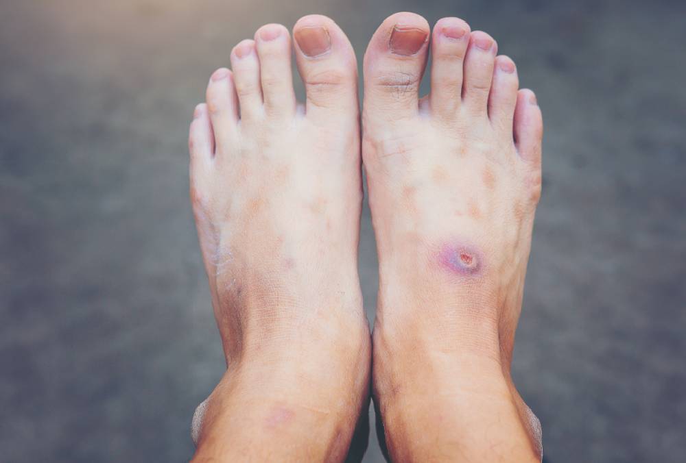 Diabetic foot