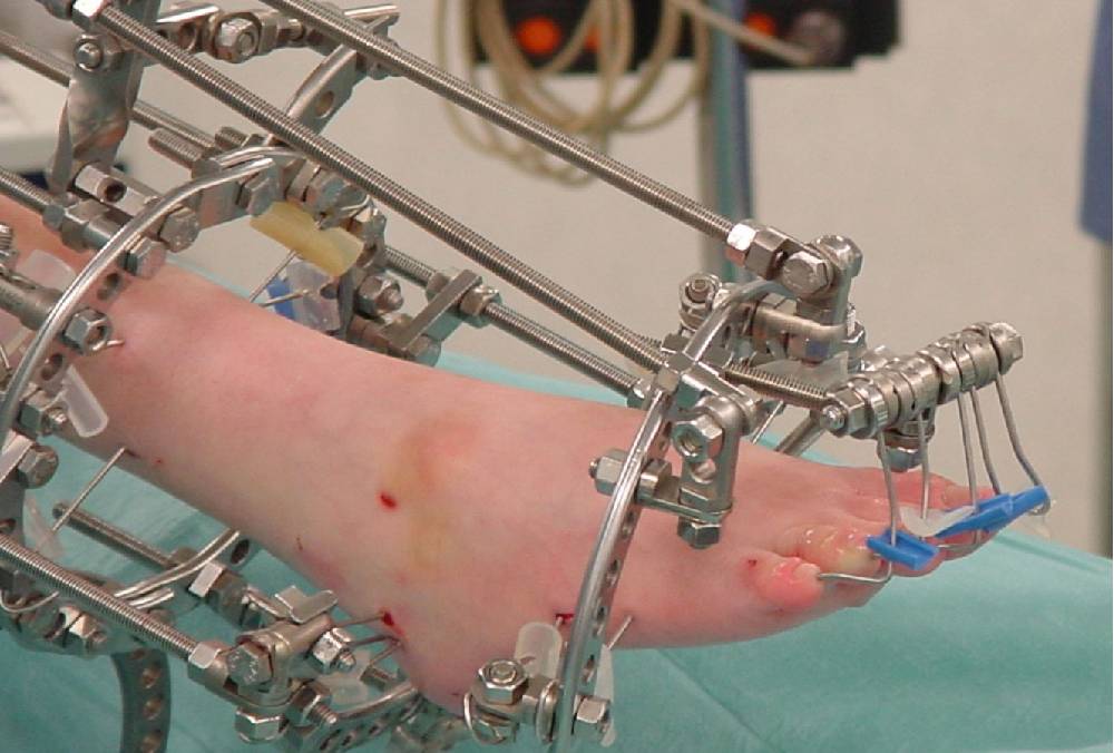 Ilizarov Surgery