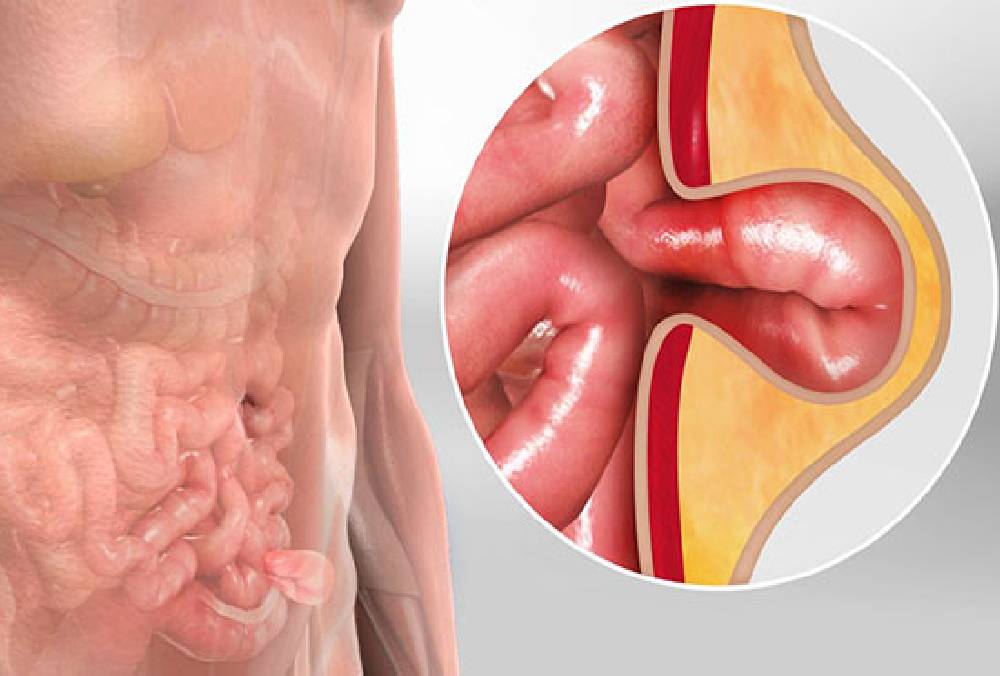 Laparoscopic Hernia Repair